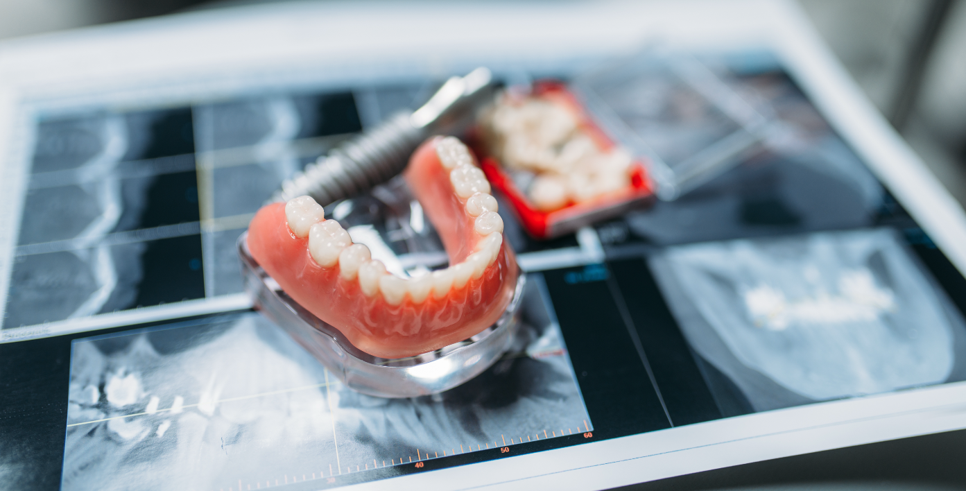 ¿Qué es una prótesis dental?