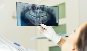 Edad recomendada para ponerse implantes dentales