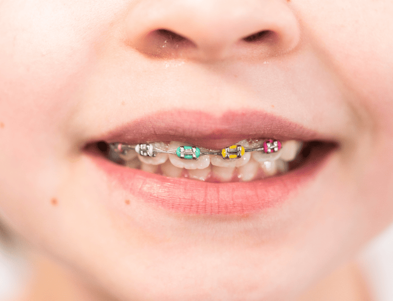 Ortodoncia infantil