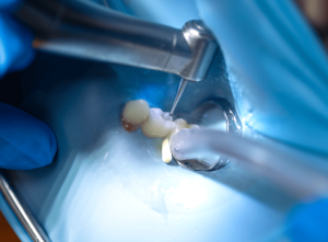 ¿Cuándo es necesaria una endodoncia?