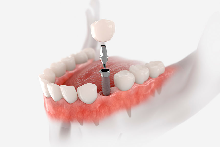 Implantes de carga inmediata