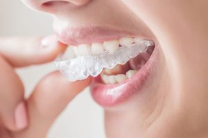 Invisalign es la marca líder en este campo, gracias a su tecnología basada en férulas transparentes