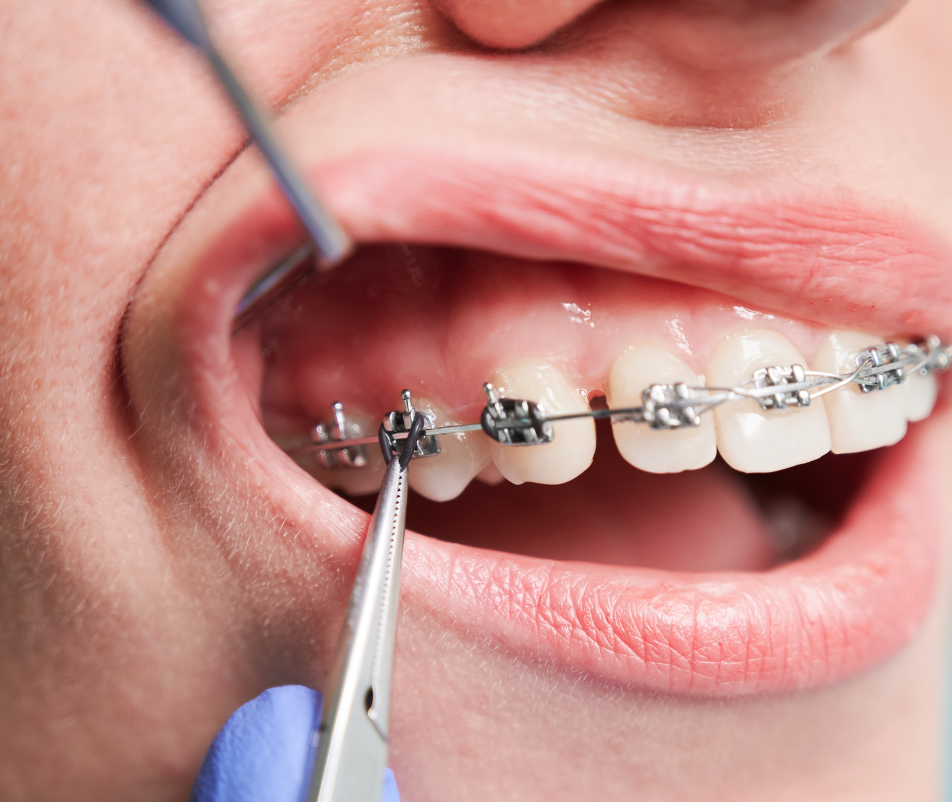 Ortodoncia con brackets